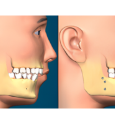 Correction of Jaw Deformities