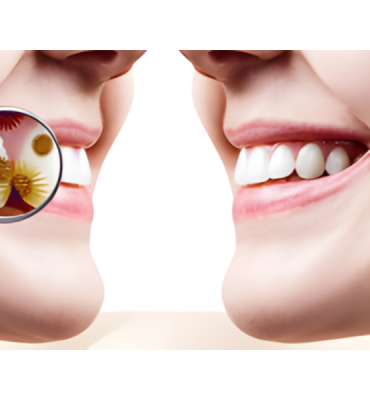 Dental & Facial Infections