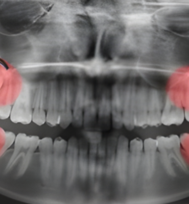 Removal of Wisdom Teeth