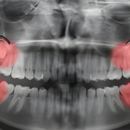 Removal of Wisdom Teeth