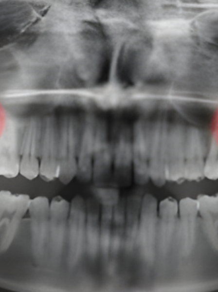 Removal of Wisdom Teeth