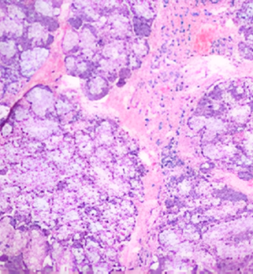 Salivary Gland Pathology