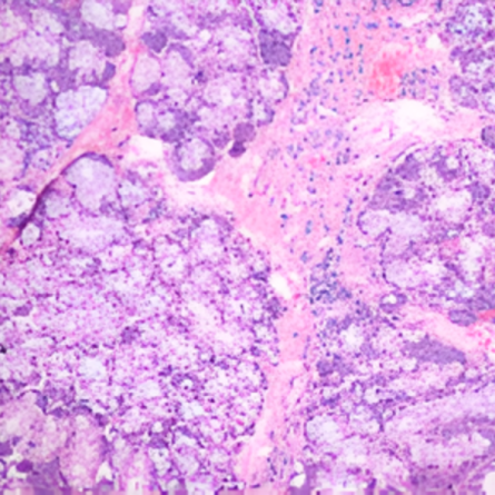 Salivary Gland Pathology